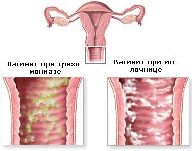 Лечение вагинита